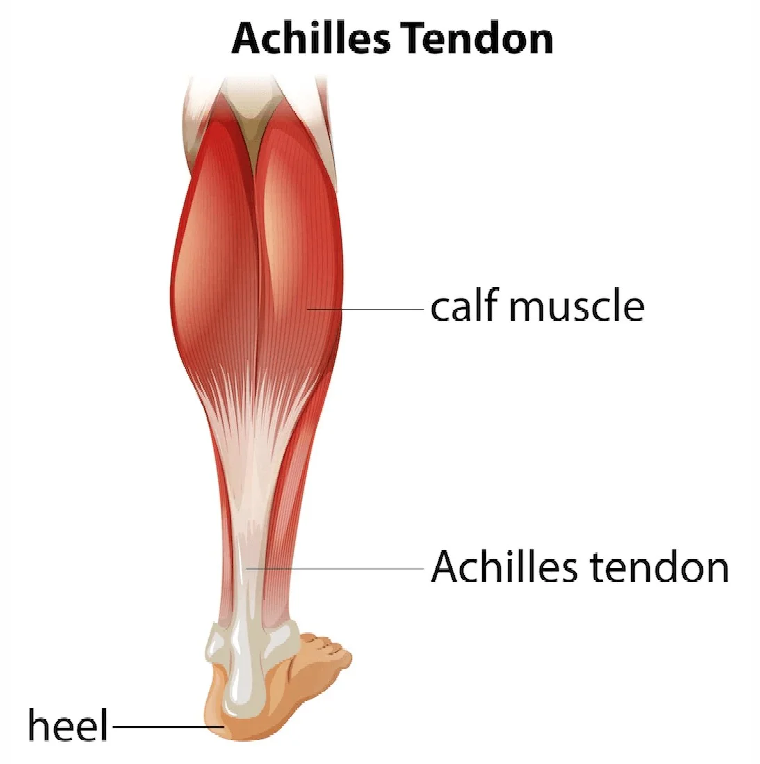 Best Treatment for Achilles Tendonitis at Gangasheel Hospital - Bareilly