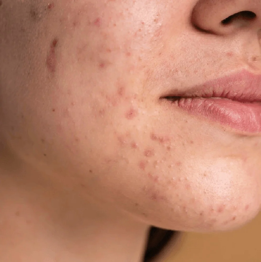 Best Treatment for Acnes at Gangasheel Hospital - Bareilly