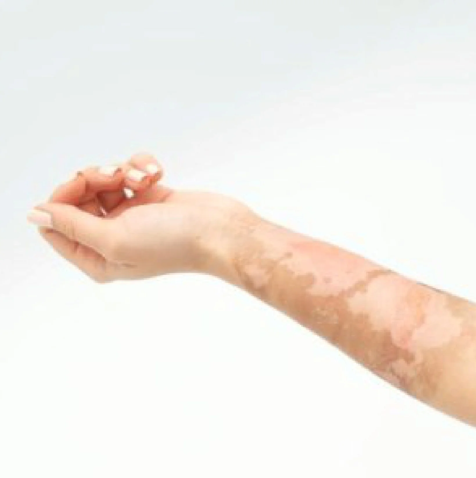 Best Treatment for Burn Skin at Gangasheel Hospital - Bareilly