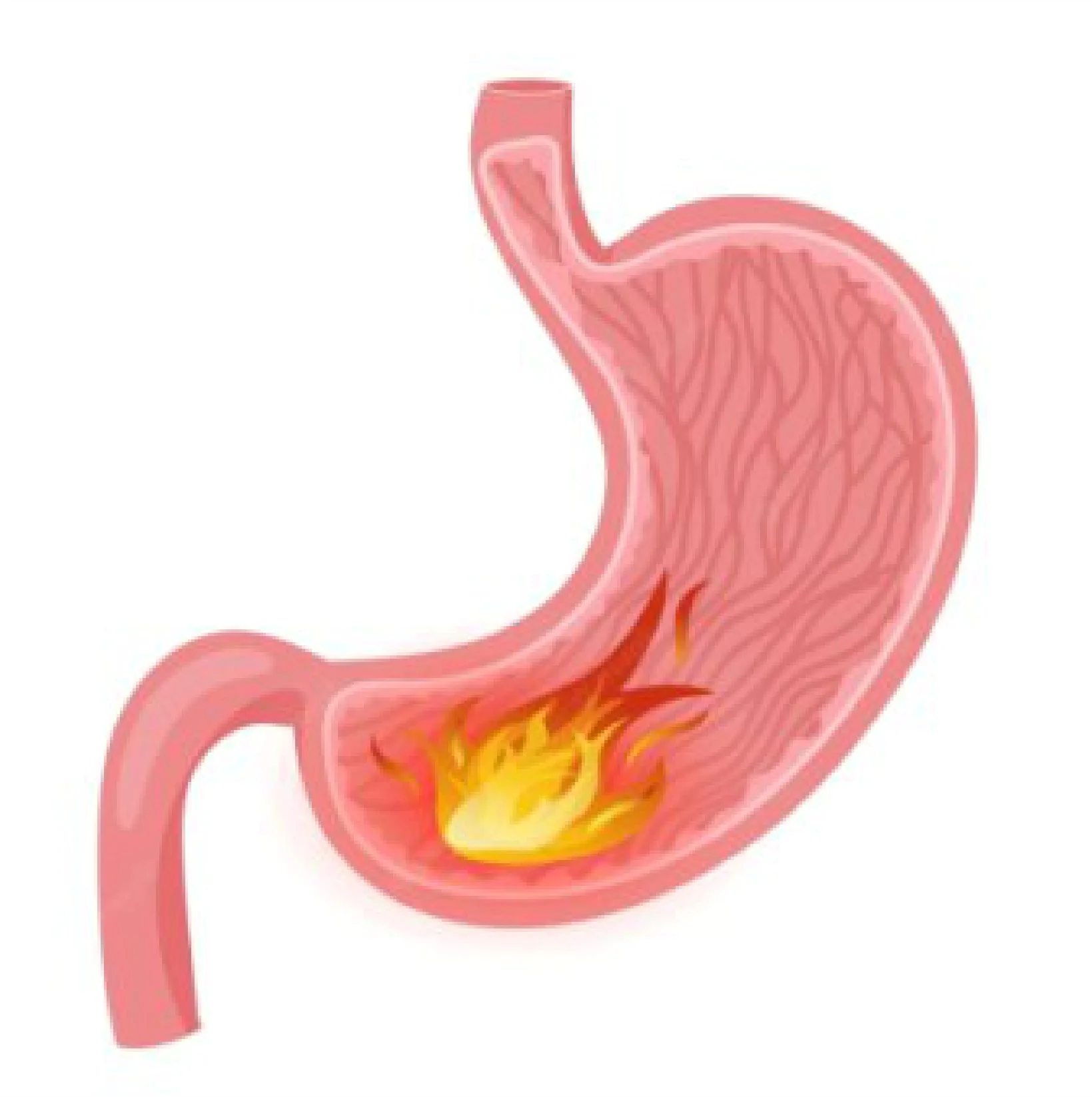 Best Treatment for Gastric Reflux at Gangasheel Hospital - Bareilly