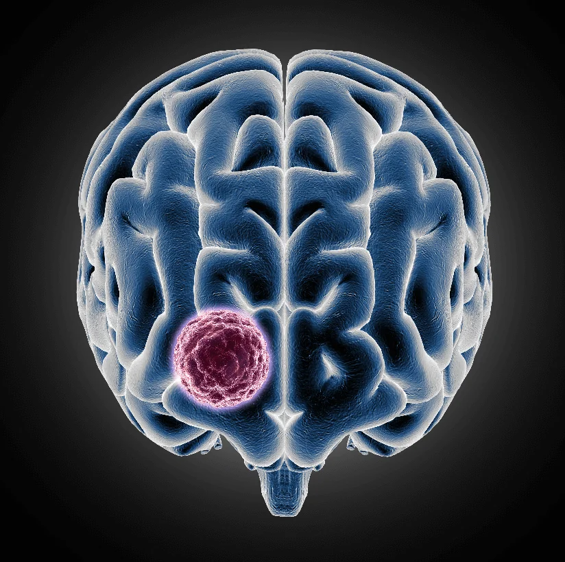 Treatment for Brain Tumor, Neuro & Spine Diseases in Bareilly - Gangasheel Hospital