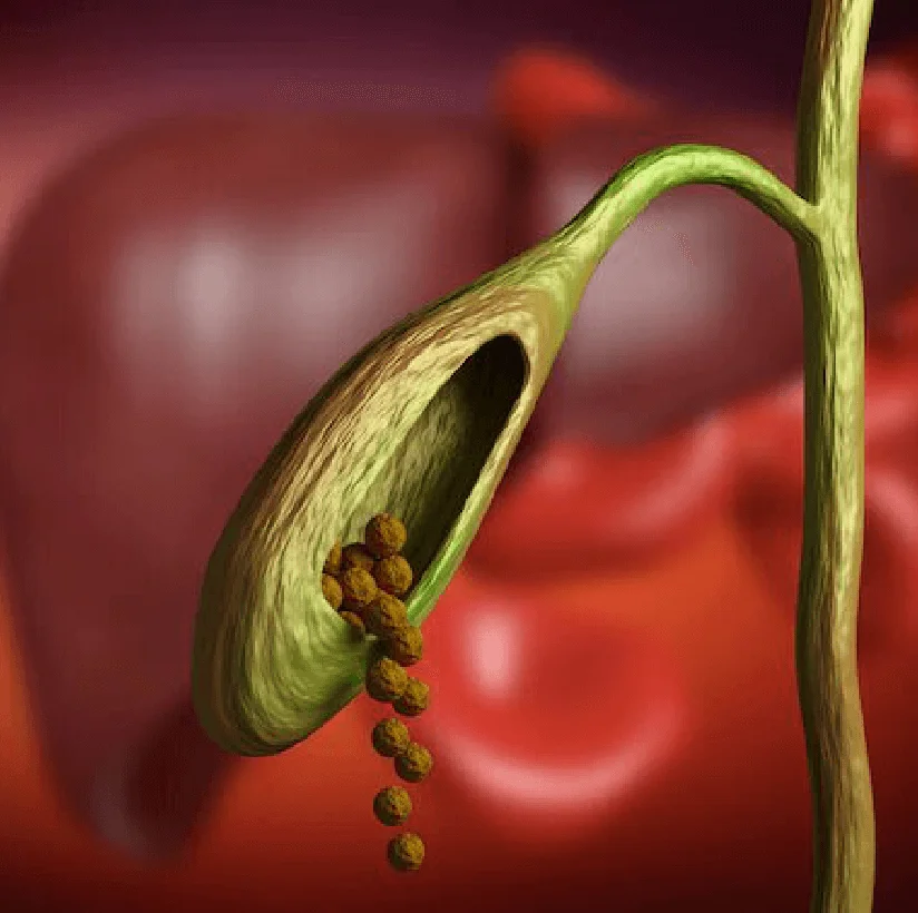 Treatment for Gall Bladder Stone in Bareilly - Gangasheel Hospital