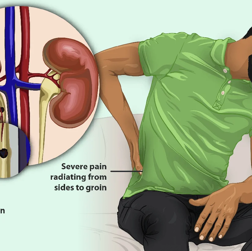 Treatment for Kidney Stone in Bareilly - Gangasheel Hospital