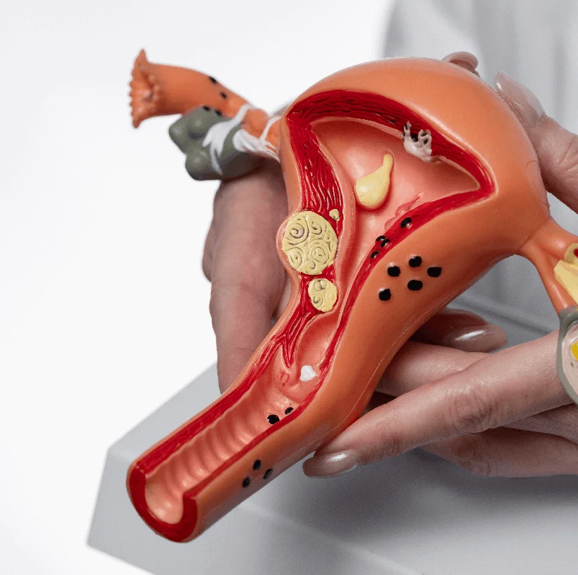 Treatment for Uterine Fibroids in Bareilly - Gangasheel Hospital